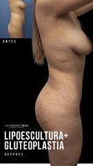 Gluteoplastia - Dr. Luis Fernando Reyes