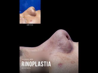 Rinoplastia-740355