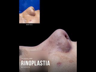 Rinoplastia - Dr. Luis Fernando Reyes