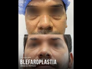Blefaroplastia - Dr. Luis Fernando Reyes