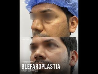 Blefaroplastia - Dr. Luis Fernando Reyes