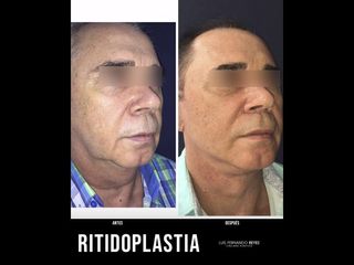 Liposucción de papada - Dr. Luis Fernando Reyes