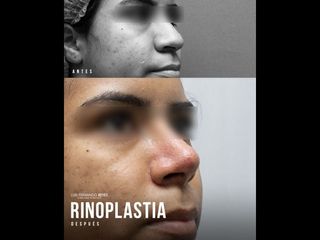Rinoplastia - Dr. Luis Fernando Reyes