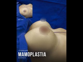 Mamoplastia de aumento - Dr. Luis Fernando Reyes