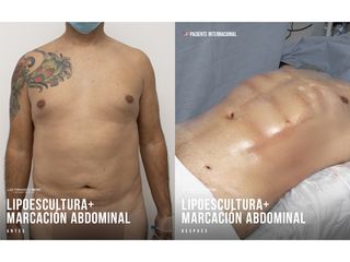 Abdominoplastia - Dr. Luis Fernando Reyes