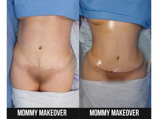 Abdominoplastia - Dr. Luis Fernando Reyes