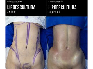 Liposucción - Dr. Luis Fernando Reyes
