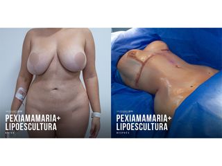 Lipoescultura - Dr. Luis Fernando Reyes
