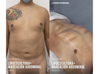Liposucción - Dr. Luis Fernando Reyes