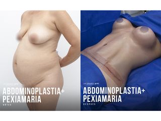 Abdominoplastia - Dr. Luis Fernando Reyes