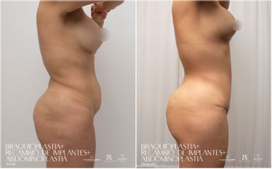 Abdominoplastia - Dr. Luis Fernando Reyes