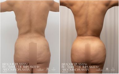 Lipoescultura - Dr. Luis Fernando Reyes