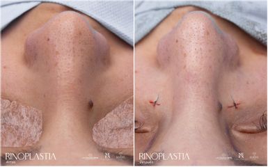 Rinoplastia - Dr. Luis Fernando Reyes