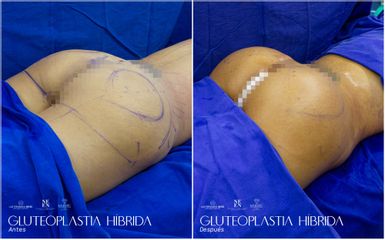 Gluteoplastia - Dr. Luis Fernando Reyes