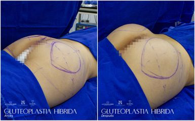 Gluteoplastia - Dr. Luis Fernando Reyes