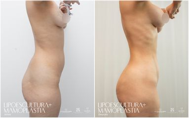 Lipoescultura - Dr. Luis Fernando Reyes