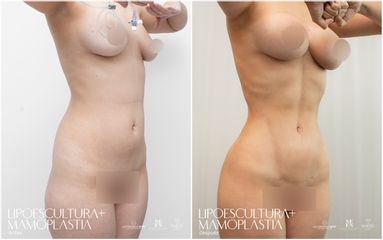 Lipoescultura - Dr. Luis Fernando Reyes