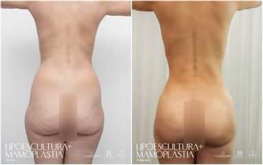 Lipoescultura - Dr. Luis Fernando Reyes