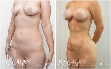 Lipoescultura - Dr. Luis Fernando Reyes