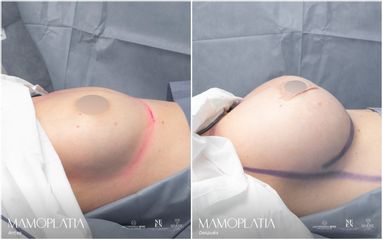 Mamoplastia de aumento - Dr. Luis Fernando Reyes