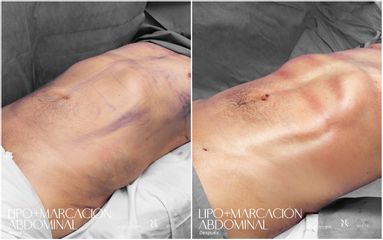 Lipomarcación Abdominal - Dr. Luis Fernando Reyes
