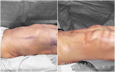 Lipomarcación Abdominal - Dr. Luis Fernando Reyes