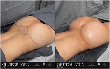 Gluteoplastia - Dr. Luis Fernando Reyes