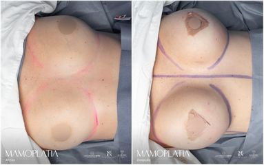 Mamoplastia de aumento - Dr. Luis Fernando Reyes