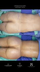 Lipoescultura - Dr. Luis Fernando Reyes