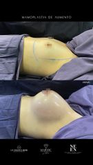 Mamoplastia de aumento - Dr. Luis Fernando Reyes