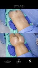 Lipoescultura - Dr. Luis Fernando Reyes
