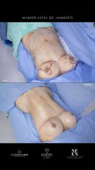 Mamoplastia de aumento - Dr. Luis Fernando Reyes