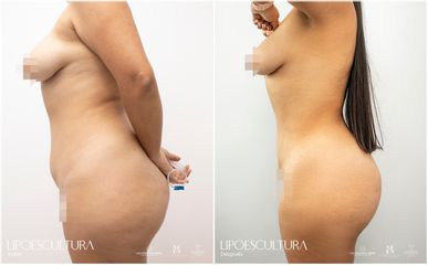 Lipoescultura - Dr. Luis Fernando Reyes