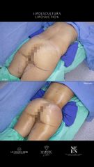 Lipoescultura - Dr. Luis Fernando Reyes