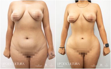 Lipoescultura - Dr. Luis Fernando Reyes
