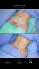 Abdominoplastia - Dr. Luis Fernando Reyes