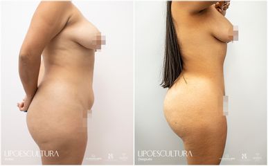 Lipoescultura - Dr. Luis Fernando Reyes