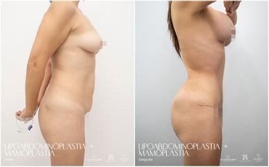 Lipoabdomindoplastia - Dr. Luis Fernando Reyes