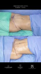Abdominoplastia - Dr. Luis Fernando Reyes
