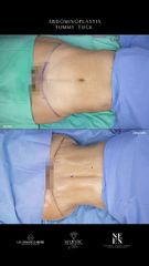 Abdominoplastia - Dr. Luis Fernando Reyes