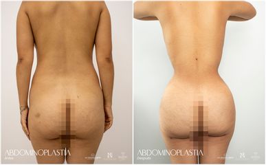 Abdominoplastia - Dr. Luis Fernando Reyes