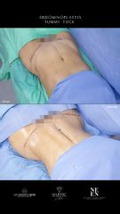 Abdominoplastia - Dr. Luis Fernando Reyes