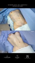 Lipoescultura - Dr. Luis Fernando Reyes