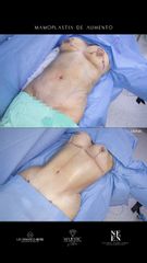 Mamoplastia de aumento - Dr. Luis Fernando Reyes