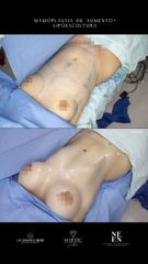 Lipoescultura - Dr. Luis Fernando Reyes