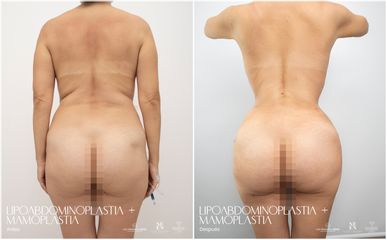Lipoabdomindoplastia - Dr. Luis Fernando Reyes