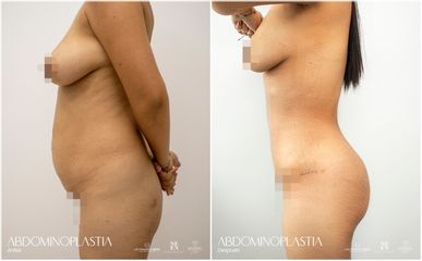 Abdominoplastia - Dr. Luis Fernando Reyes