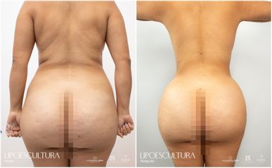 Lipoescultura - Dr. Luis Fernando Reyes
