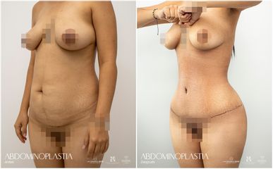 Abdominoplastia - Dr. Luis Fernando Reyes