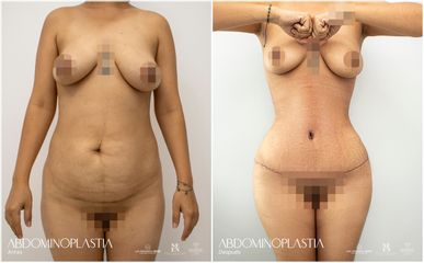 Abdominoplastia - Dr. Luis Fernando Reyes